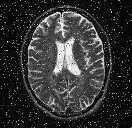 پردازش تصویر با استفاده از MATLAB – قسمت سوم : فیلتر های فضایی 7 تصویر MRI با نویز نمک و فلفل