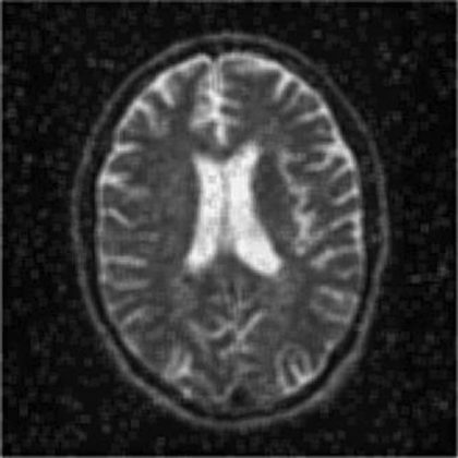 تصویر MRI بعد از حذف نویز نمک و فلفل